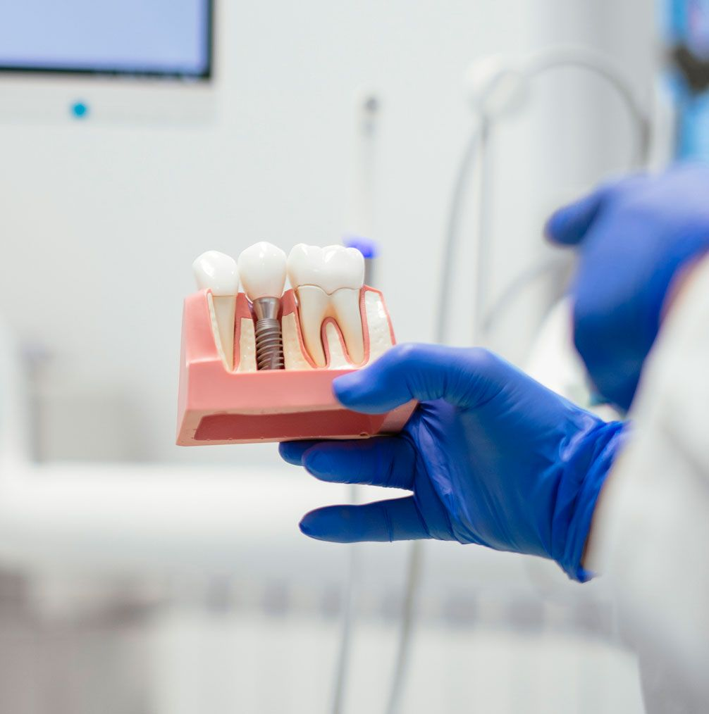 Dentist holding a dental implant model showing a titanium implant beside natural teeth